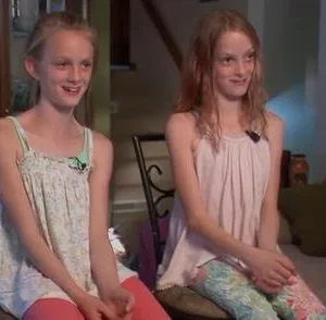 Conjoined twins who underwent surgery to separate them over eighteen years ago are now normal teenagers. Conjoined twins who underwent surgery to separate them over eighteen years ago are now normal teenagers.