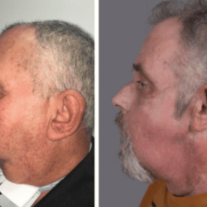 First Successful Face Transplant in Canada Gives New Hope to Patients