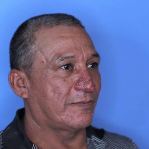 The Remarkable Transformation of Conrado’s Nose The Remarkable Transformation of Conrado’s Nose