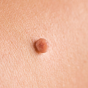 Don’t attempt to take off skin tags on your own.