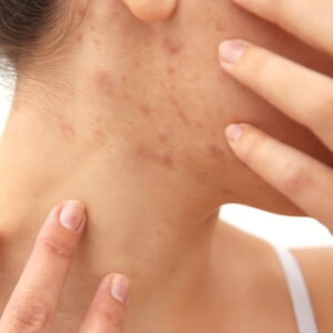 How Acne on These 5 Body Parts Reflects Your Daily Habits