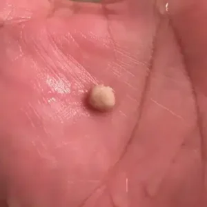 Everything you need know about tonsil stones, odd growths that seem like pimples in your throat.