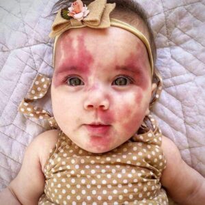 Mom paints face to match daughter’s port wine birthmark Mom paints face to match daughter’s port wine birthmark
