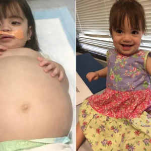 Little girl who looked 8 months’ pregnant because of deadly disease is saved thanks to dad’s kidney donation