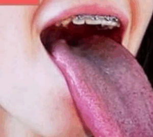 What White Tongue Is, and What to Do About It