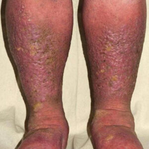 How Your Feet Could Be Signaling Heart Problems and Clogged Arteries