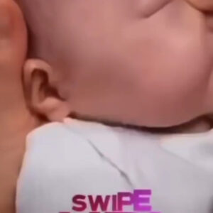 Extraction of inflammatory acne in babies