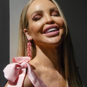 Katie Piper Shares Inspiring Update 16 Years After Surviving Acid Attack: Unexpected Details!