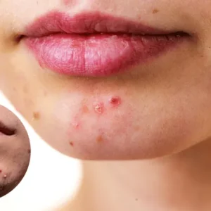 8 Body Parts Acnes Can Appear And What Triggers Them