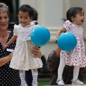 After a complex and risky operation doctors managed to separate these conjoined twin sisters